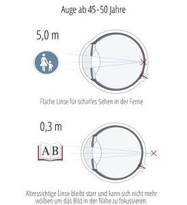 Ursachen der Altersweitsichtigkeit Die Ursache der Altersweitsichtigkeit verstehen